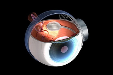 Бионический глаз Argus II поможет слепым увидеть мир